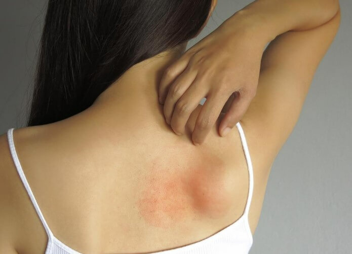 Urgent Care for Skin Rash