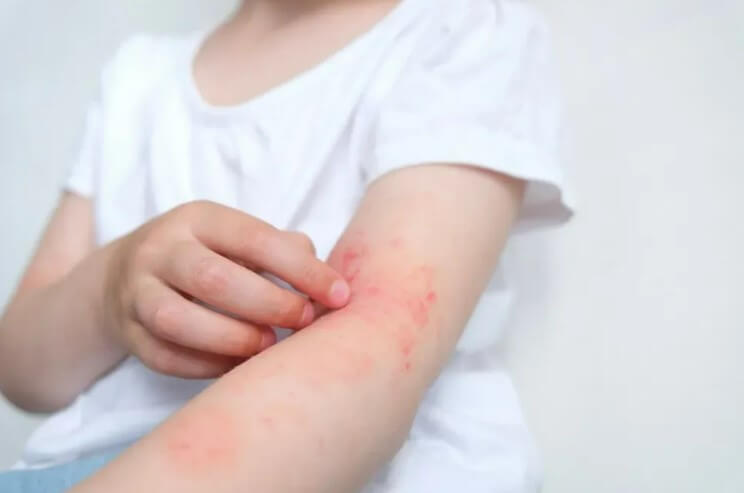 Urgent Care for Skin Rash